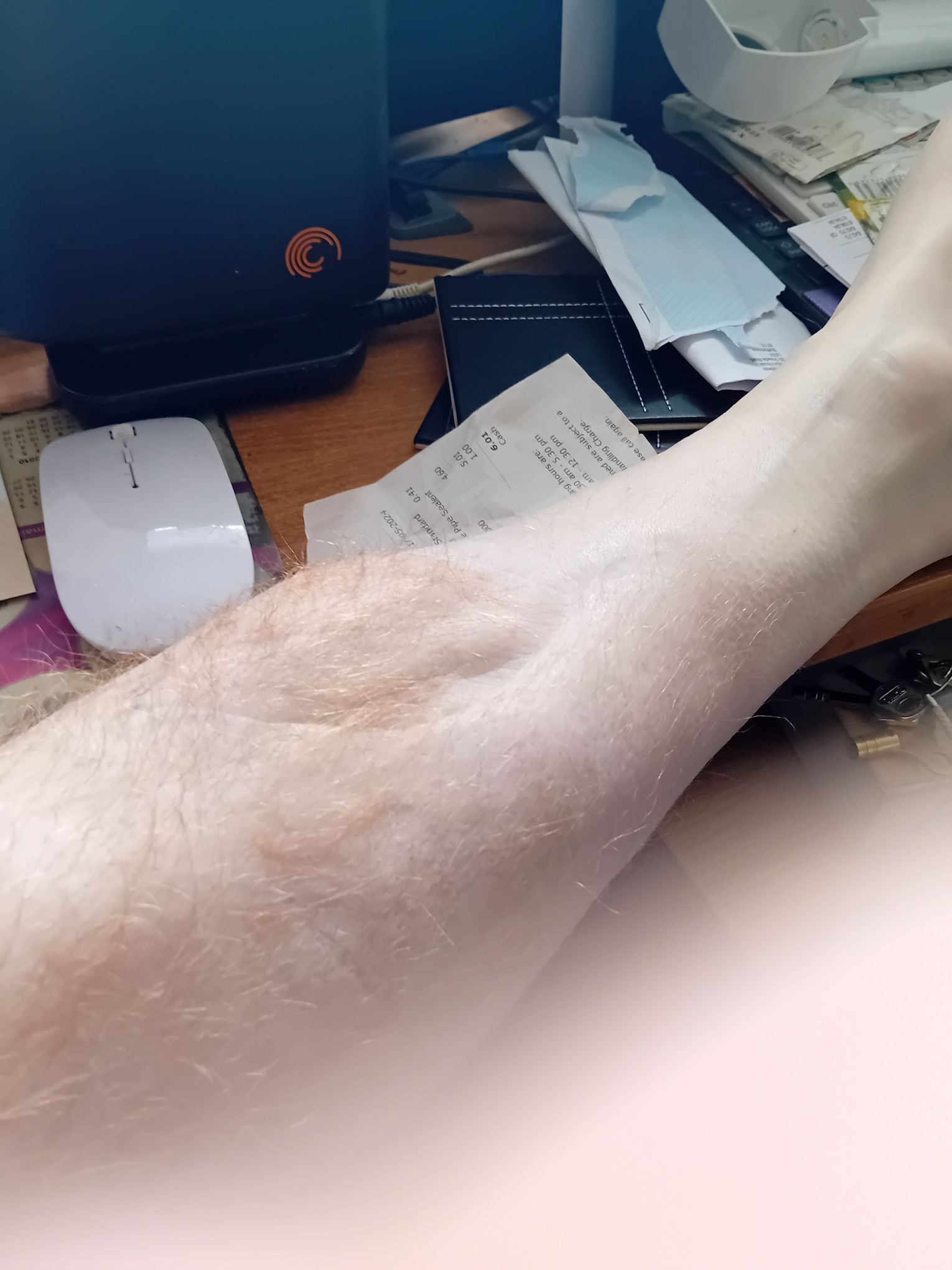 Some ugly pictures of my broken leg Bringing Revolution to Private